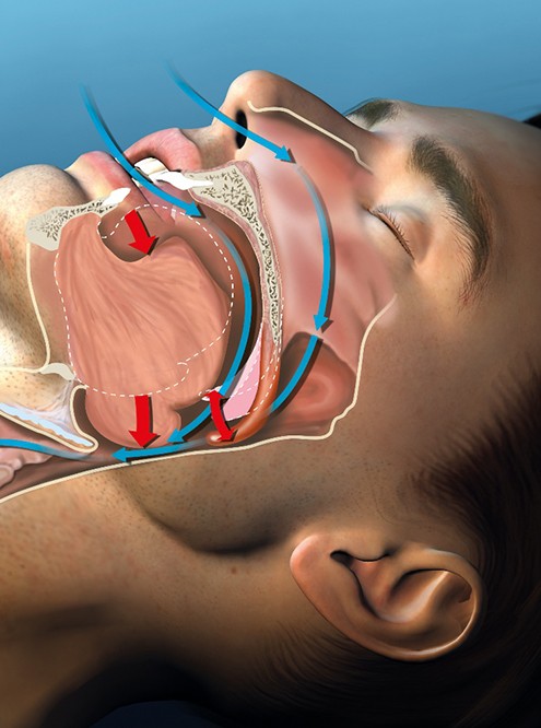 a computer illustration showing a sleeping man’s airflow
