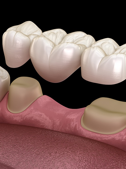 A 3D illustration of a dental bridge