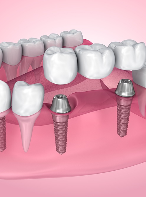 A 3D illustration of an implant bridge