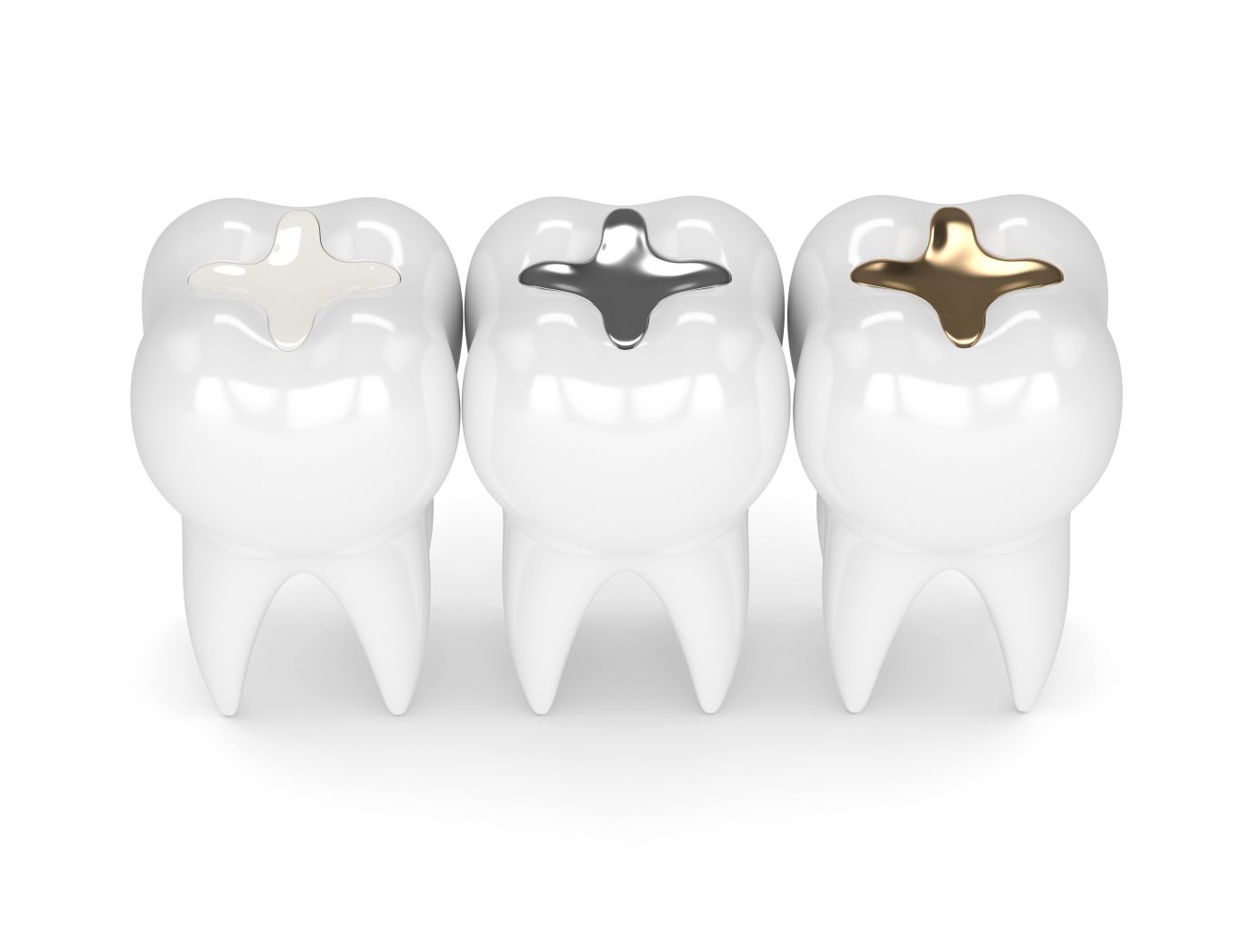 3d Render Of Teeth With Different Types Of Dental Filling