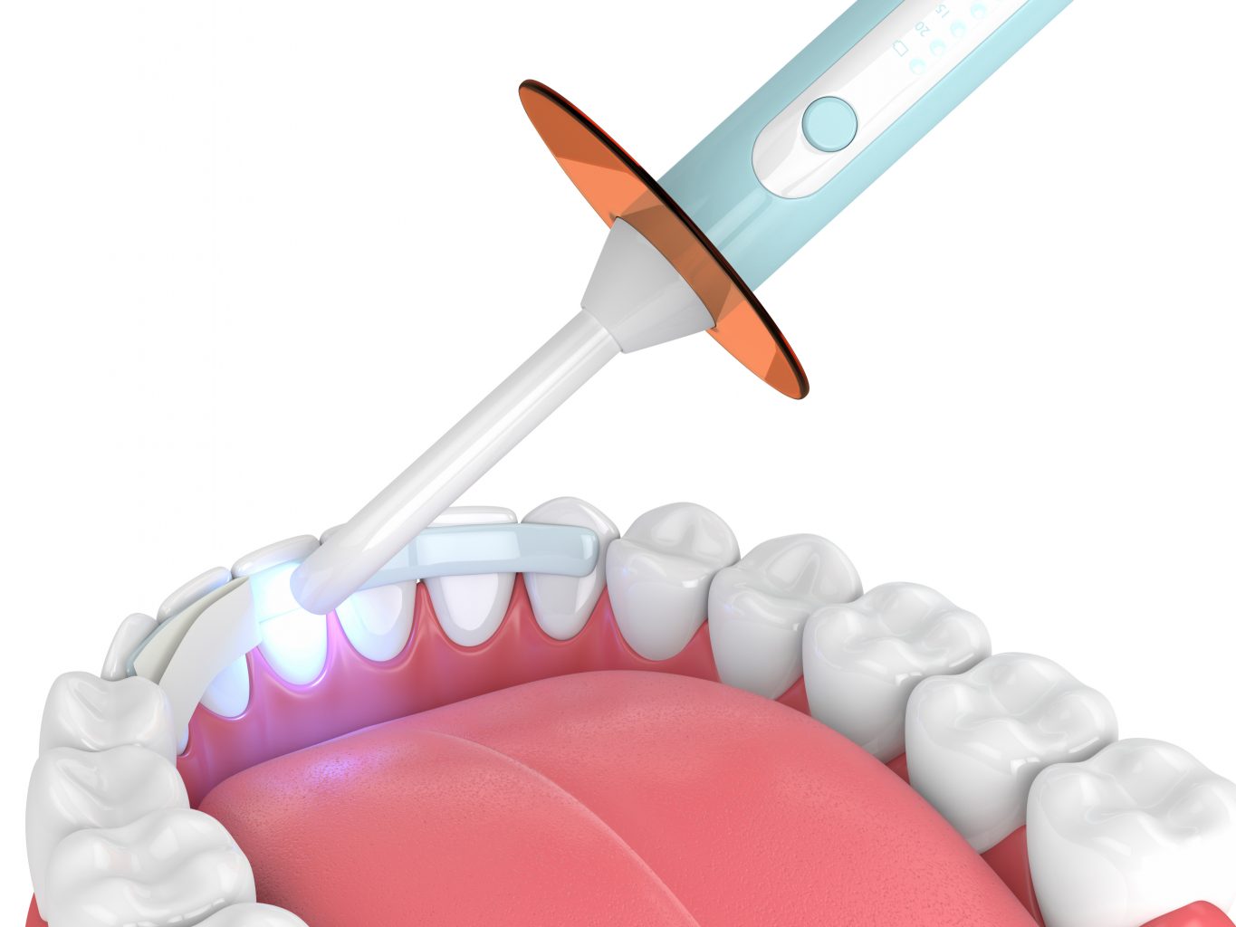 3d Render Of Jaw With Dental Polymerization Lamp And Dental Fiber